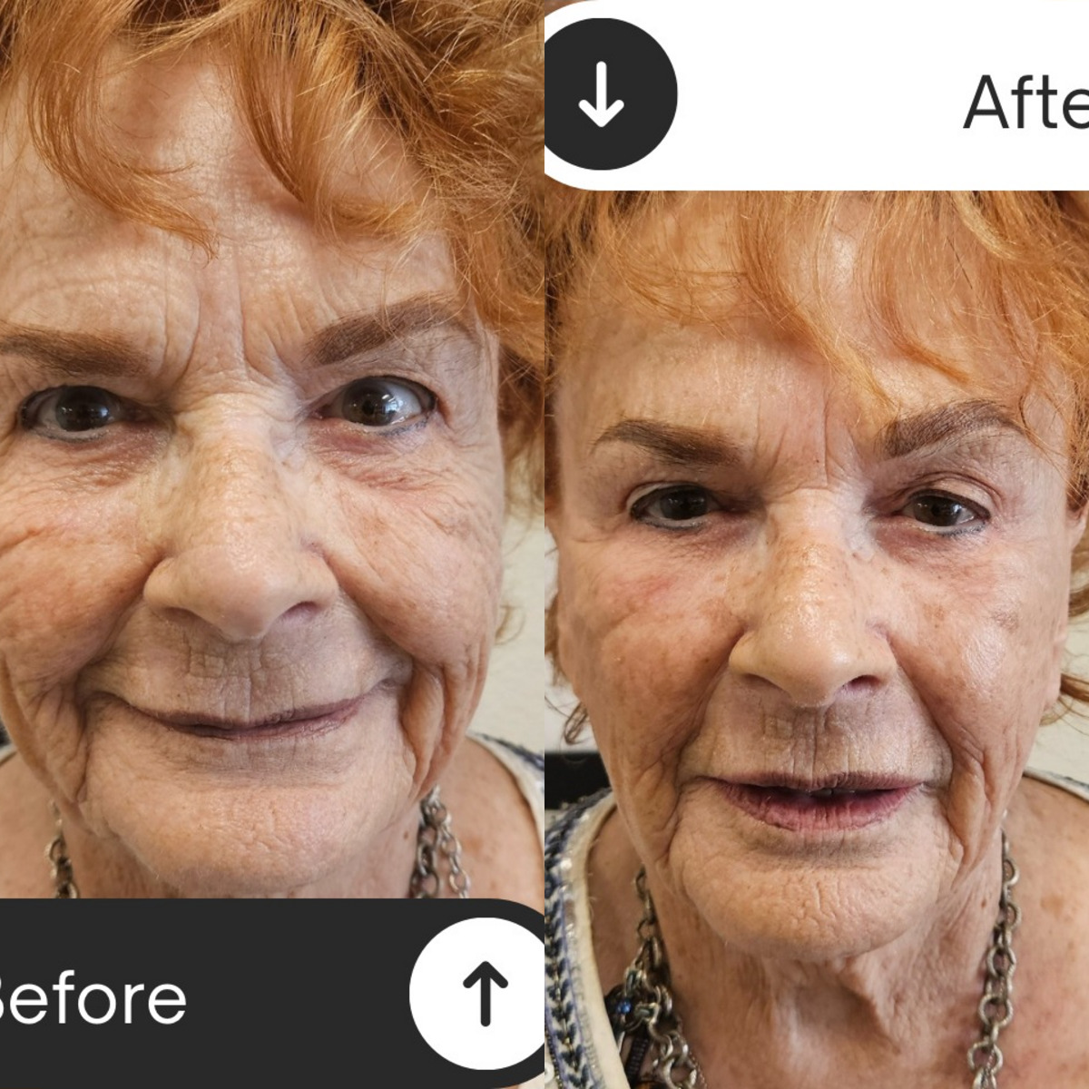 Before and after comparison showing double chin reduction and neck tightening after a single treatment session